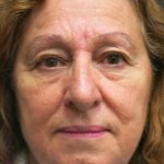 Rhinoplasty Before & After Patient #2891