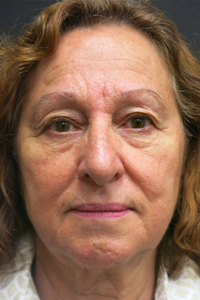 Rhinoplasty Before & After Patient #2891