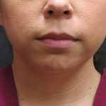 Chin Augmentation Before & After Patient #1561