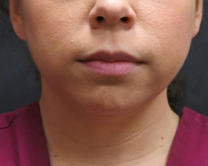Chin Augmentation Before & After Patient #1561