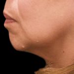 Chin Augmentation Before & After Patient #1566