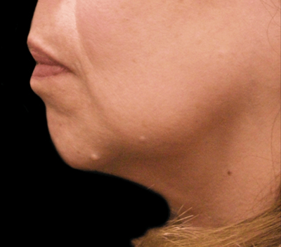 Chin Augmentation Before & After Patient #1566