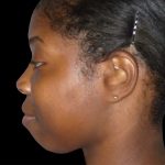 Chin Augmentation Before & After Patient #1554
