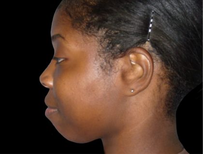 Chin Augmentation Before & After Patient #1554
