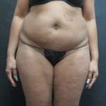 Mommy Makeover Before & After Patient #2618