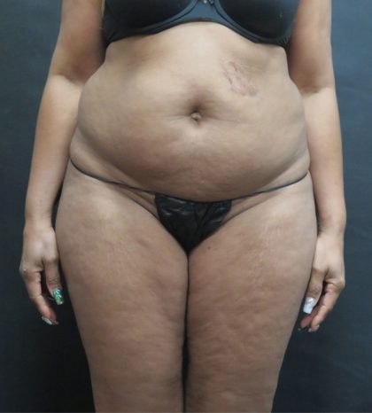 Mommy Makeover Before & After Patient #2618