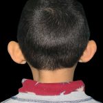 Ear Reshaping Before & After Patient #1572