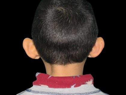 Ear Reshaping Before & After Patient #1572