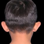 Ear Reshaping Before & After Patient #1569