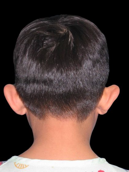 Ear Reshaping Before & After Patient #1569