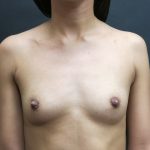Breast Augmentation Before & After Patient #1066