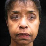 Fat Transfer Before & After Patient #1770
