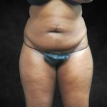 Mommy Makeover Before & After Patient #2587