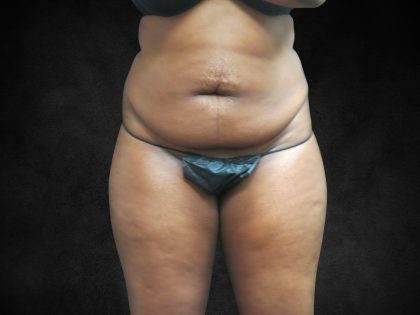 Mommy Makeover Before & After Patient #2587