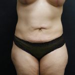 Mommy Makeover Before & After Patient #2490