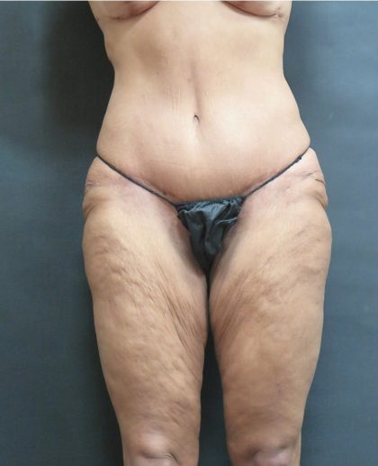 Thigh Lift Before & After Patient #3118