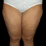 Thigh Lift Before & After Patient #3128