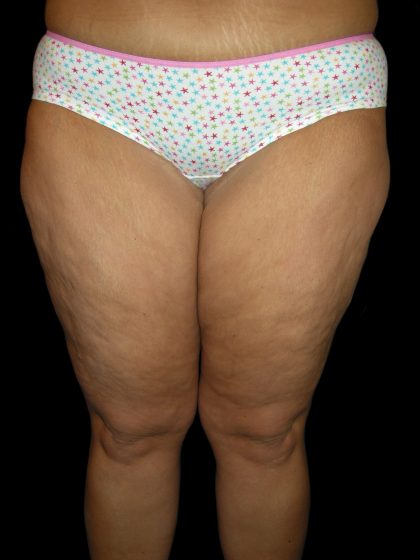 Thigh Lift Before & After Patient #3128