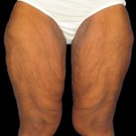 Thigh Lift Before & After Patient #3137