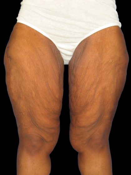 Thigh Lift Before & After Patient #3137