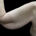 Arm Lift Before & After Patient #904