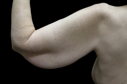 Arm Lift Before & After Patient #904