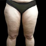 Thigh Lift Before & After Patient #3113