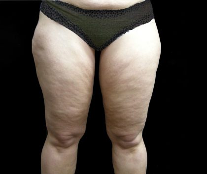 Thigh Lift Before & After Patient #3113