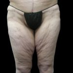 Thigh Lift Before & After Patient #3123