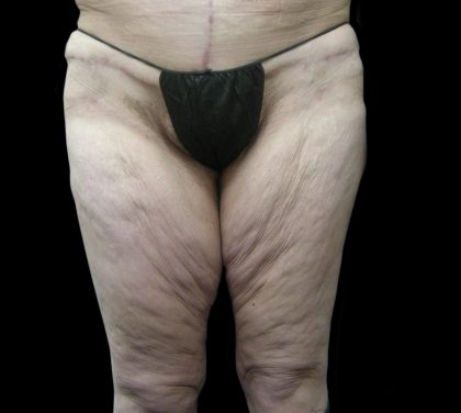 Thigh Lift Before & After Patient #3123