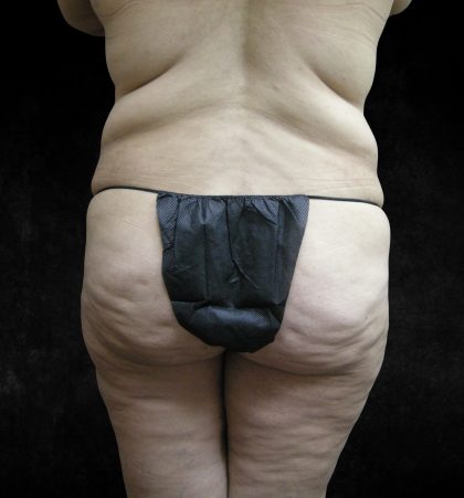 BBL / Brazilian Butt Lift / Gluteal Fat transfer Before & After Patient #1540
