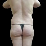 BBL / Brazilian Butt Lift / Gluteal Fat transfer Before & After Patient #1533