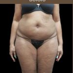 Liposuction Before & After Patient #2175