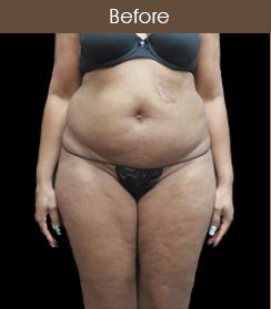 Liposuction Before & After Patient #2175