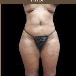 Liposuction Before & After Patient #2175