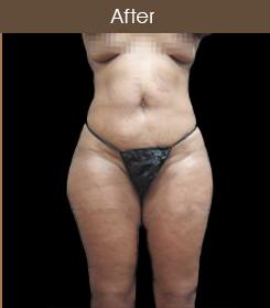 Liposuction Before & After Patient #2175