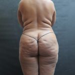 BBL / Brazilian Butt Lift / Gluteal Fat transfer Before & After Patient #1530