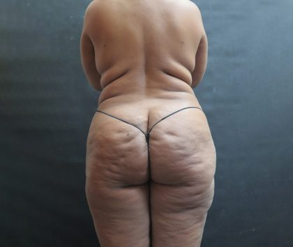 BBL / Brazilian Butt Lift / Gluteal Fat transfer Before & After Patient #1530