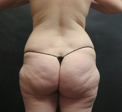 BBL / Brazilian Butt Lift / Gluteal Fat transfer Before & After Patient #1511