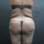 BBL / Brazilian Butt Lift / Gluteal Fat transfer Before & After Patient #1490
