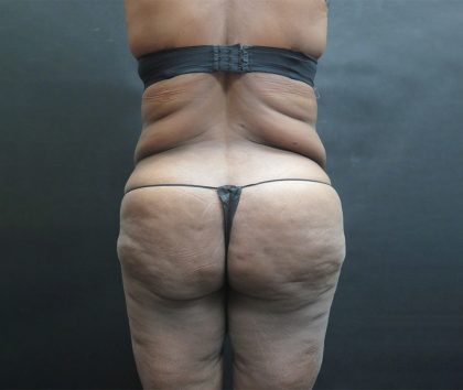 BBL / Brazilian Butt Lift / Gluteal Fat transfer Before & After Patient #1490