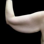 Arm Lift Before & After Patient #897