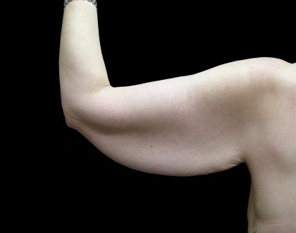 Arm Lift Before & After Patient #897