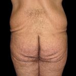 BBL / Brazilian Butt Lift / Gluteal Fat transfer Before & After Patient #1523