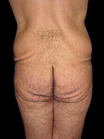 BBL / Brazilian Butt Lift / Gluteal Fat transfer Before & After Patient #1523