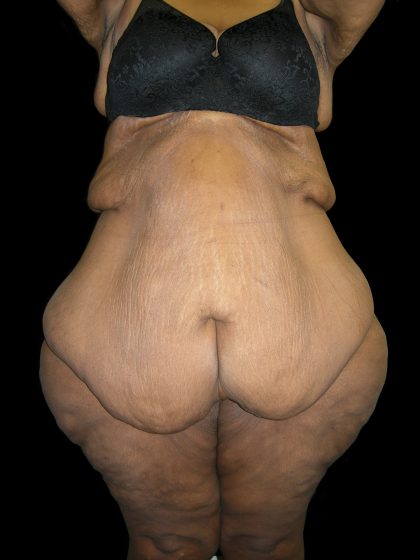 Post Weight Loss Before & After Patient #2749