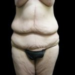 Post Weight Loss Before & After Patient #2770