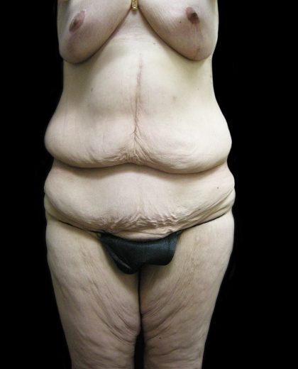 Post Weight Loss Before & After Patient #2770