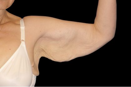 Arm Lift Before & After Patient #913