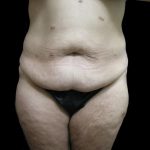 Post Weight Loss Before & After Patient #2791